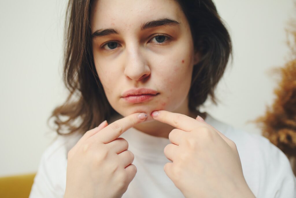 8-Ways-to-Reduce-Acne-Scarring